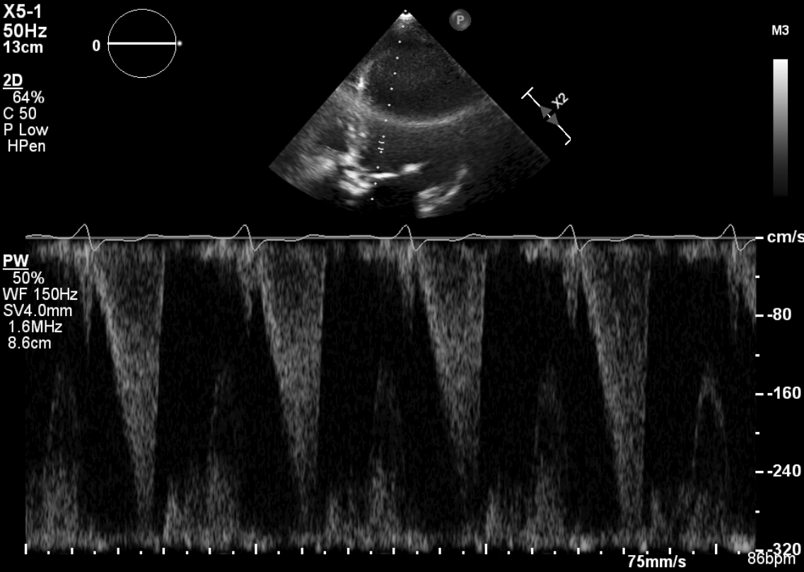 CW Doppler tracing showing late-peaking dagger-shaped signal in LVOT